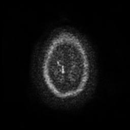 Cerebellar hemangioblastoma (Radiopaedia 29570-30077 Axial DWI 26).jpg