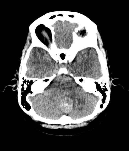 Cerebellar metastases - colorectal adenocarcinoma (Radiopaedia 40947-43652 Axial non-contrast 15).png
