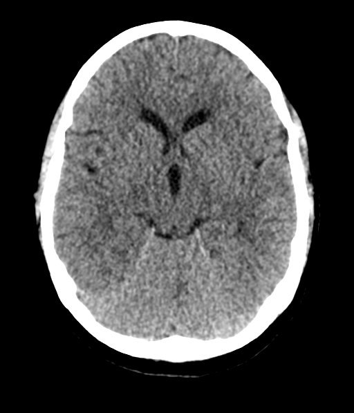Cerebellar metastases - colorectal adenocarcinoma (Radiopaedia 40947-43652 Axial non-contrast 27).png