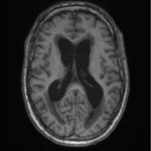 Cerebellar metastasis from lung adenocarcinoma (Radiopaedia 86690-102829 Axial T1 46).png