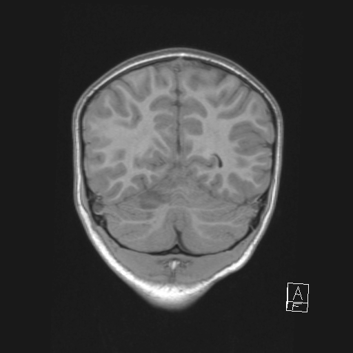 Cerebellar stroke (Radiopaedia 32202-33150 Coronal T1 46).png