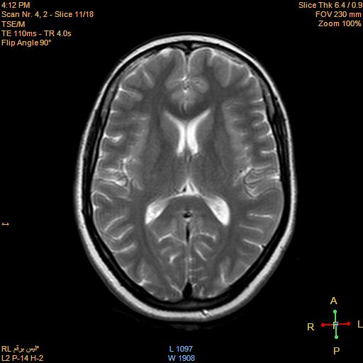File:Cerebellopontine angle meningioma (Radiopaedia 22488-22525 Axial T2 9).jpg