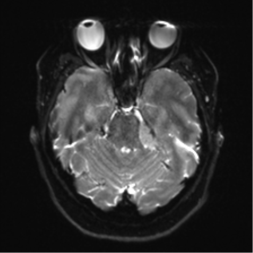 Cerebellopontine angle meningioma (Radiopaedia 48434-53348 Axial DWI 12).png