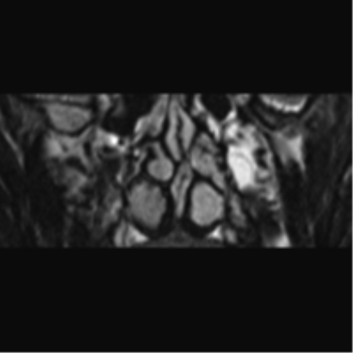 Cerebellopontine angle meningioma (Radiopaedia 48434-53348 Coronal T2 95).png