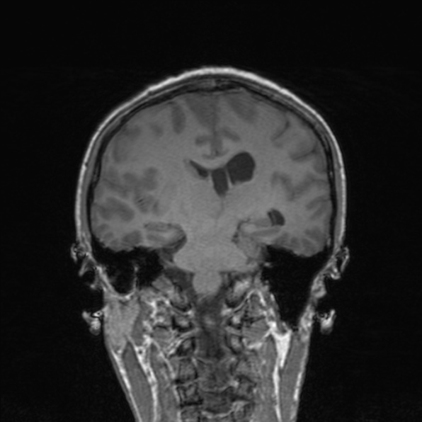 Cerebral abscess (Radiopaedia 24212-24478 Coronal T1 124).jpg