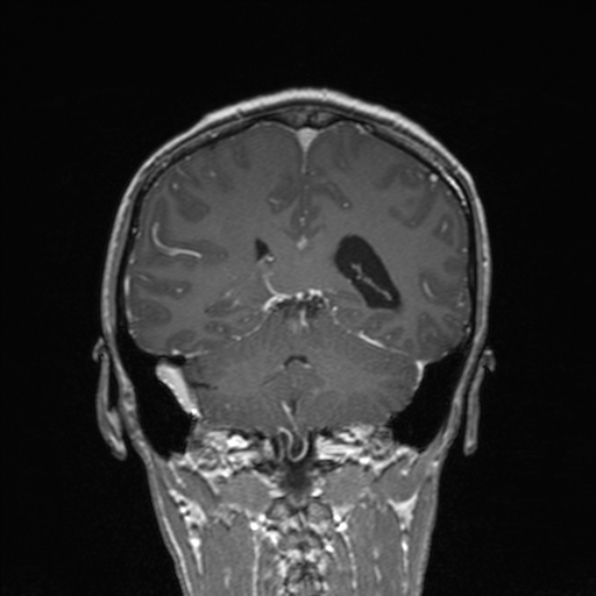 Cerebral abscess (Radiopaedia 24212-24478 Coronal T1 C+ 139).jpg