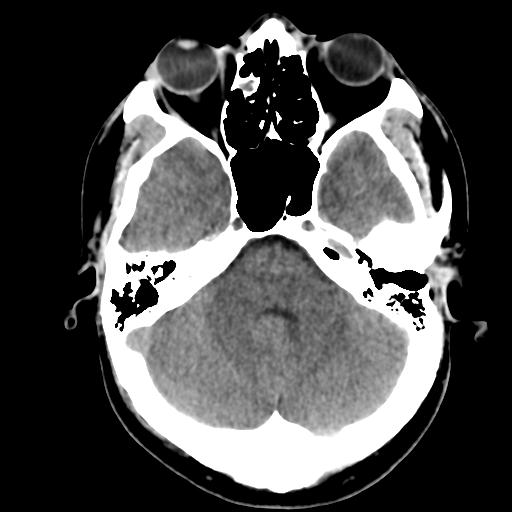 File:Cerebral abscess (Radiopaedia 29451-29919 Axial non-contrast 13).jpg