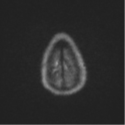 Cerebral abscess (Radiopaedia 60342-68009 Axial DWI 71).png