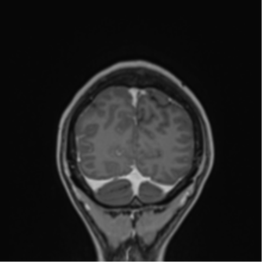 Cerebral abscess (Radiopaedia 60342-68009 H 2).png