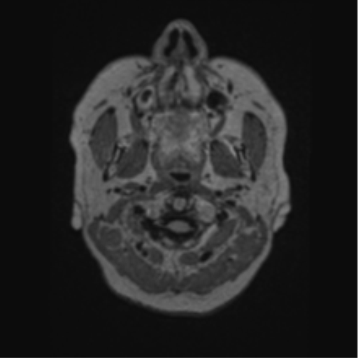 Cerebral abscess from pulmonary arteriovenous malformation (Radiopaedia 86275-102291 J 1).png