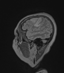 Cerebral abscess from pulmonary arteriovenous malformation (Radiopaedia 86275-102291 Sagittal FLAIR 62).png