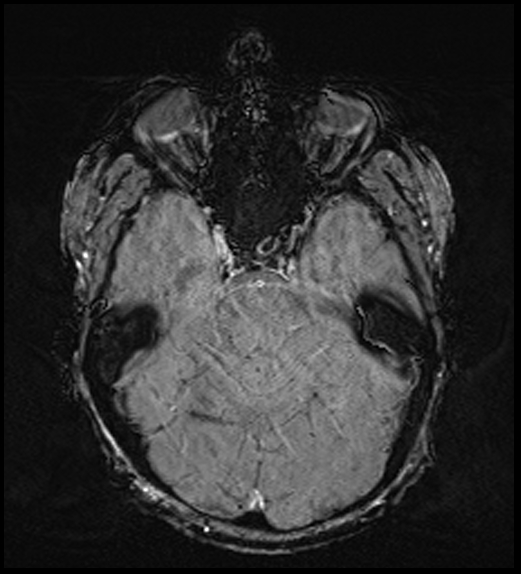 Cerebral abscess with ventriculitis (Radiopaedia 78965-91878 Axial SWI 20).jpg