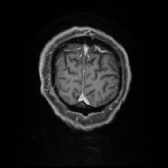 Cerebral abscess with ventriculitis (Radiopaedia 78965-91878 Coronal T1 C+ 59).jpg