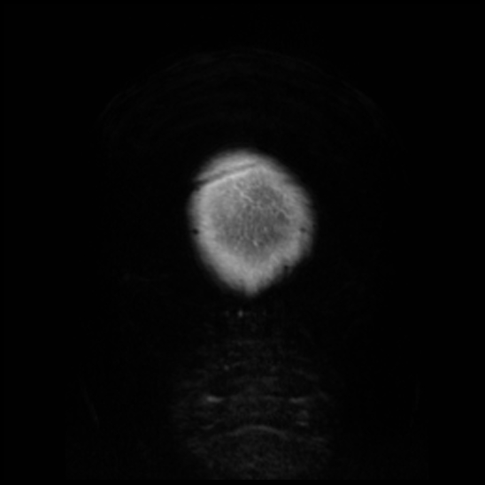 Cerebral abscess with ventriculitis (Radiopaedia 78965-91878 Coronal T1 C+ 67).jpg