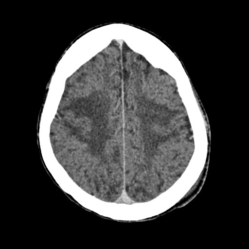 Cerebral amyloid angiopathy-related inflammation (Radiopaedia 74836-85848 Axial non-contrast 45).jpg