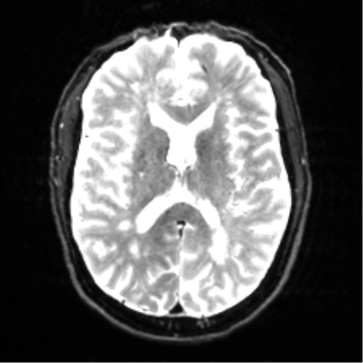 Cerebral amyloid angiopathy (Radiopaedia 46082-50433 Axial DWI 15).png