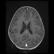 Cerebral and spinal tuberculosis (Radiopaedia 90489-107837 Axial T1 C+ 125).jpg