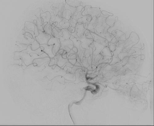 File:Cerebral angiographic projections (Radiopaedia 46308-50712 G 1).jpg