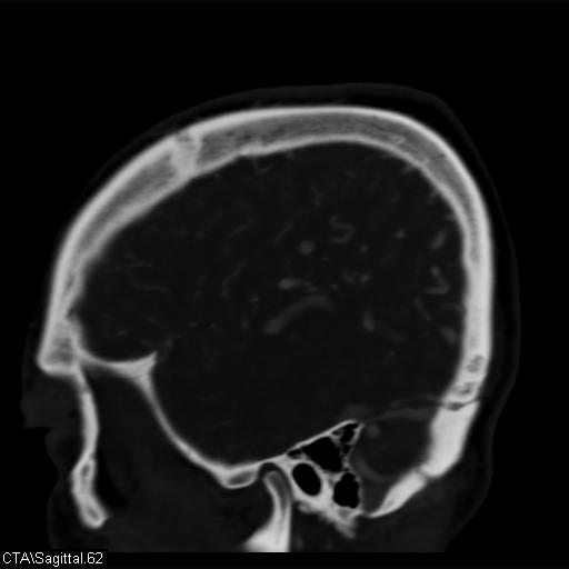 Cerebral arteriovenous malformation (Radiopaedia 28518-28759 D 59).jpg