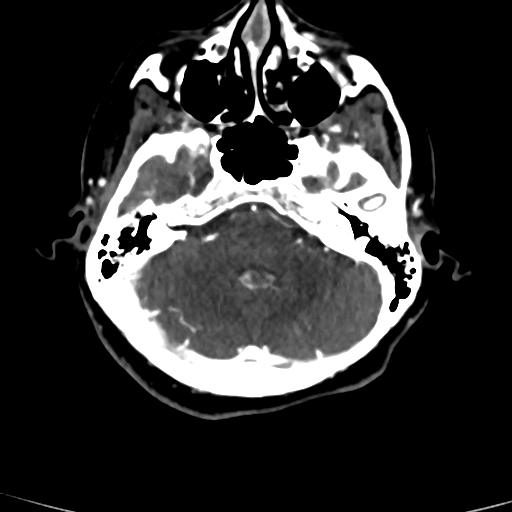 Cerebral arteriovenous malformation (Radiopaedia 73830-84645 Axial C+ delayed 71).jpg