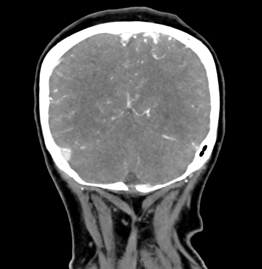 Cerebral arteriovenous malformation (Radiopaedia 73830-84645 C 76).jpg