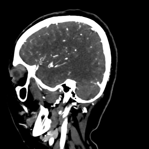 Cerebral arteriovenous malformation (Radiopaedia 73830-84645 Sagittal C+ delayed 71).jpg