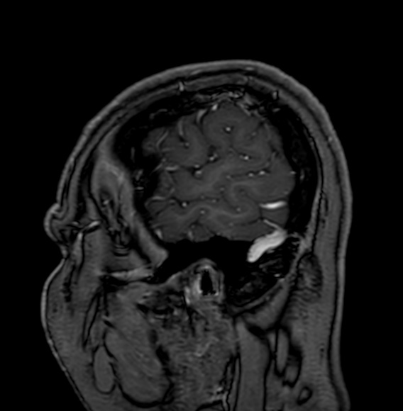 Cerebral arteriovenous malformation (Radiopaedia 74411-85746 Sagittal T1 C+ 8).jpg