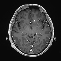 Cerebral arteriovenous malformation (Radiopaedia 84015-99245 Axial T1 C+ 72).jpg
