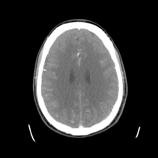 Cerebral arteriovenous malformation (Spetzler-Martin grade 2) (Radiopaedia 41262-44076 Axial C+ 34).png
