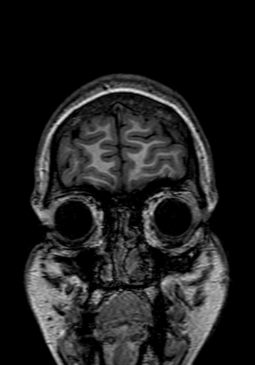Cerebral arteriovenous malformation at posterior body of corpus callosum (Radiopaedia 74111-84925 Coronal T1 9).jpg