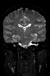 Cerebral arteriovenous malformation at posterior body of corpus callosum (Radiopaedia 74111-84925 Coronal T2 99).jpg