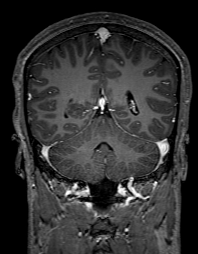 Cerebral arteriovenous malformation at posterior body of corpus callosum (Radiopaedia 74111-84925 K 259).jpg