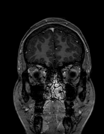 Cerebral arteriovenous malformation at posterior body of corpus callosum (Radiopaedia 74111-84925 K 49).jpg