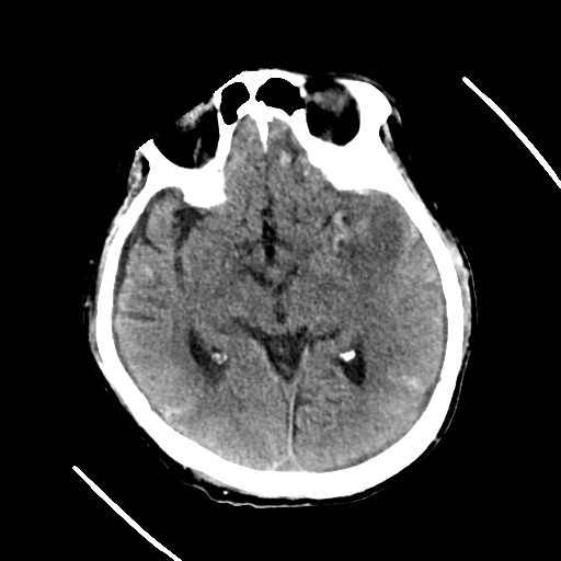 File:Cerebral contusions, subarachnoid hemorrhage and subdural hygromas (Radiopaedia 55399-61829 Axial non-contrast 19).png