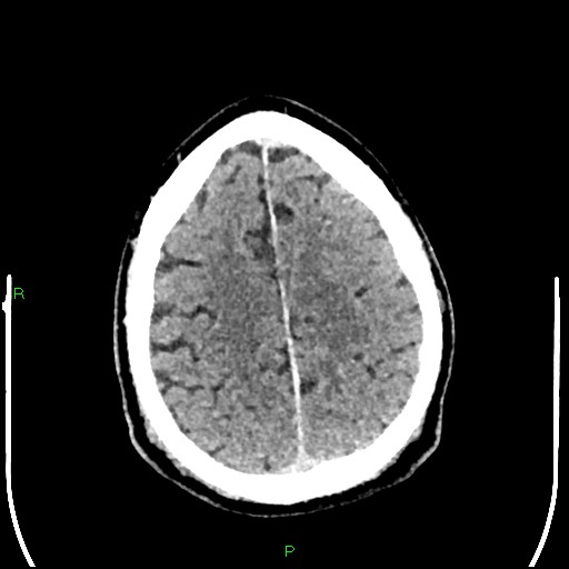 File:Cerebral contusions (Radiopaedia 33868-35039 Axial non-contrast 171).jpg