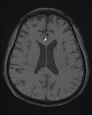 Cerebral embolic infarcts (embolic shower) (Radiopaedia 72391-82921 Axial MRA 122).jpg