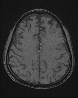 Cerebral embolic infarcts (embolic shower) (Radiopaedia 72391-82921 Axial MRA 145).jpg