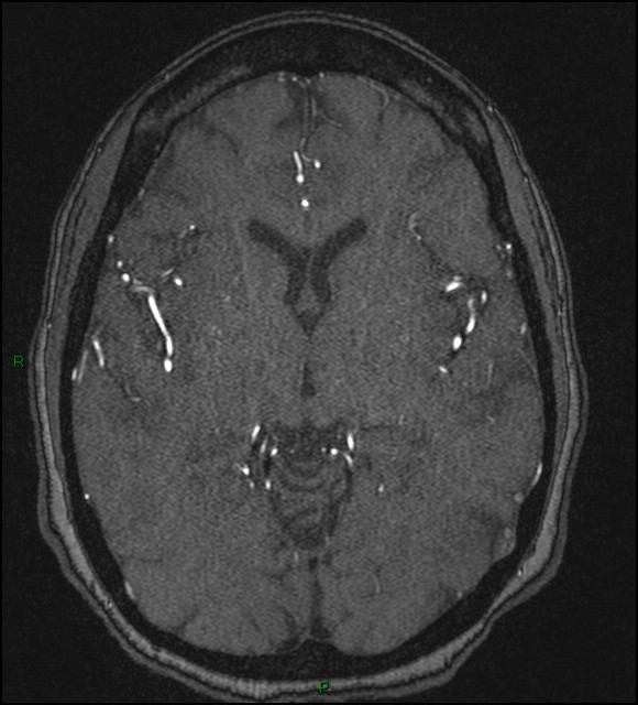 Cerebral fat embolism (Radiopaedia 35022-36525 Axial TOF 100).jpg