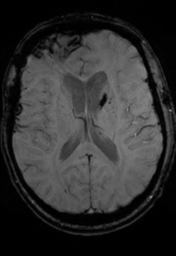 File:Cerebral hemorrhagic contusions- temporal evolution (Radiopaedia 40224-42757 D 22).png