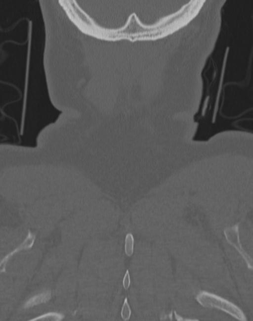 Cerebral hemorrhagic contusions and cervical spine fractures (Radiopaedia 32865-33841 Coronal bone window 76).jpg