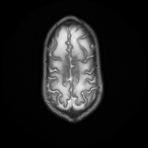 File:Cerebral manifestations of mucopolysaccharidosis type I (Radiopaedia 59171-66487 Axial T2 19).jpg