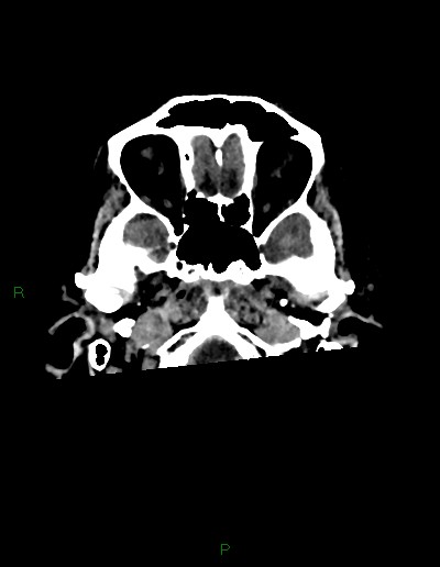 Cerebral metastases - ependymal and parenchymal (Radiopaedia 79877-93131 Axial non-contrast 3).jpg