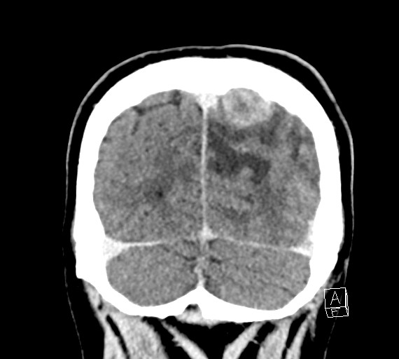 Cerebral metastases - testicular choriocarcinoma (Radiopaedia 84486-99855 D 53).jpg