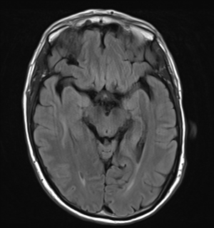 File:Cerebral metastasis - melanoma (Radiopaedia 54718-60954 Axial FLAIR 13).png