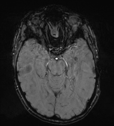 Cerebral metastasis - melanoma (Radiopaedia 54718-60954 Axial SWI 21).png