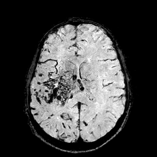 Cerebral parenchymal arteriovenous malformation (Radiopaedia 27280-27456 Axial SWI 70).jpg