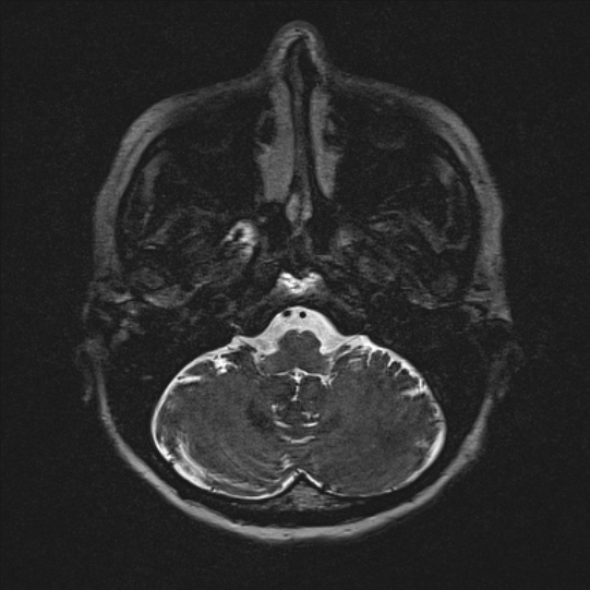 Cerebral ring enhancing lesions - cerebral metastases (Radiopaedia 44922-48817 F 15).jpg