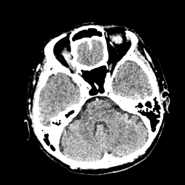 Cerebral ring enhancing lesions - cerebral metastases (Radiopaedia 44922-48818 B 87).jpg