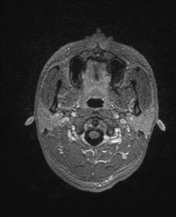 Cerebral toxoplasmosis (Radiopaedia 85779-101597 Axial T1 C+ 8).jpg