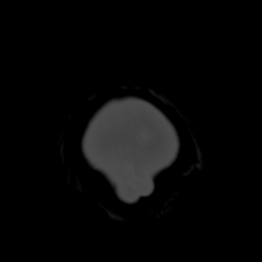 Cerebral tuberculosis with dural sinus invasion (Radiopaedia 60353-68018 Axial bone window 69).jpg